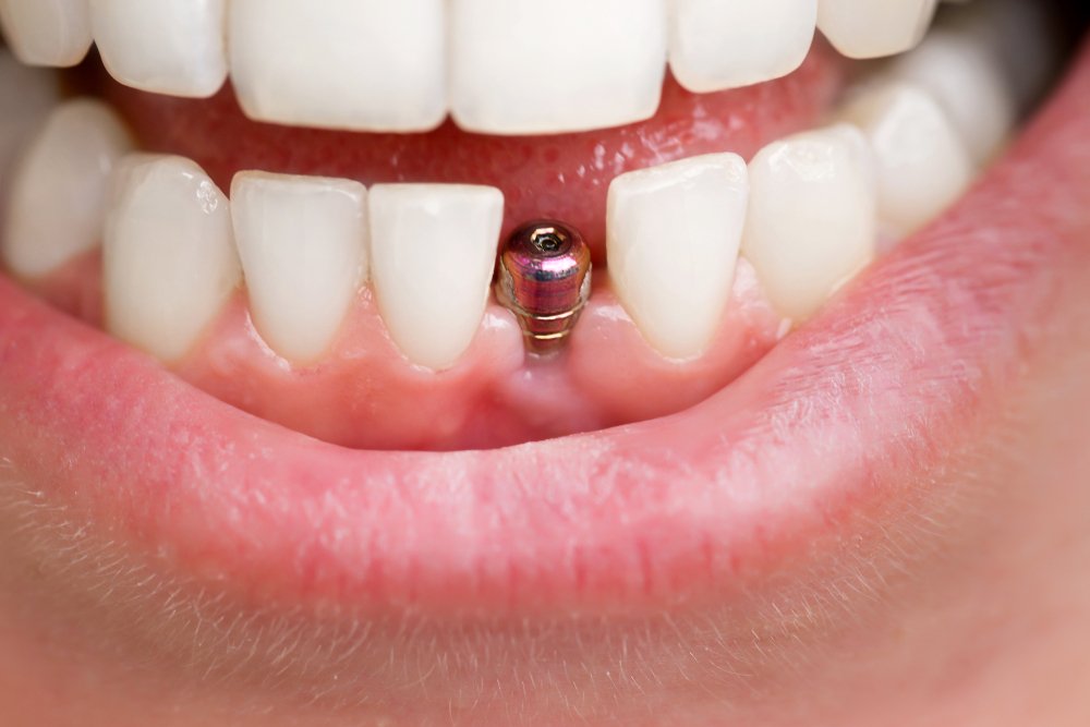 Dental Implants in Monmouth