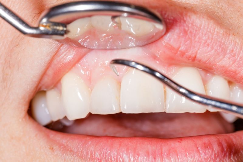 Treat Gum Disease